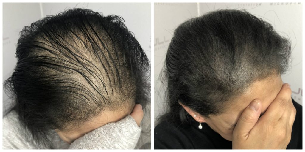 What is scalp micropigmentation and how does it help with hair loss?